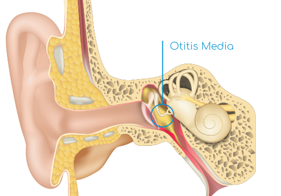 Otitis Media Diagram